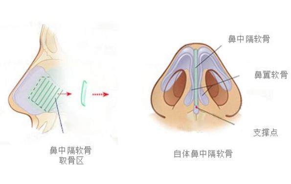 软骨垫鼻尖