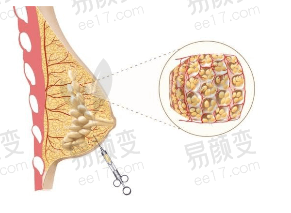 南宁华美赵广生隆胸技术怎么样？