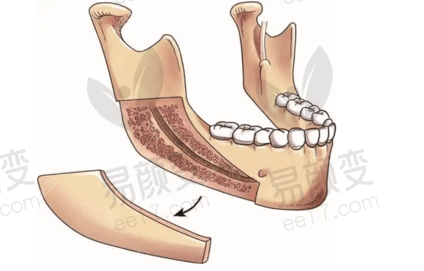 重庆华美整形外科医院何才伟下颌角磨骨实例分享