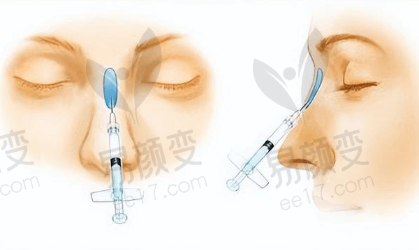 辽宁曙光整形外科医院打玻尿酸怎么样？