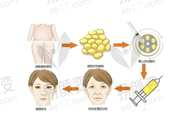 徐州华美医疗整形医院李亚飞做面部填充怎么样？