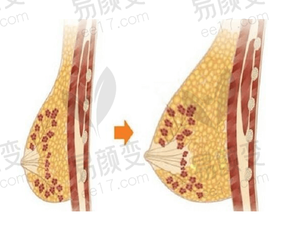 深圳非凡梅够明隆胸实例分享